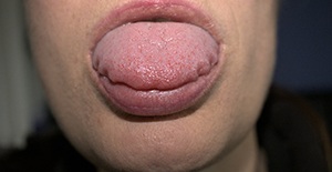 Close-up of woman with a swollen tongue